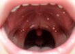 😷 White Spots on Tonsils? Causes & Treatments Revealed!